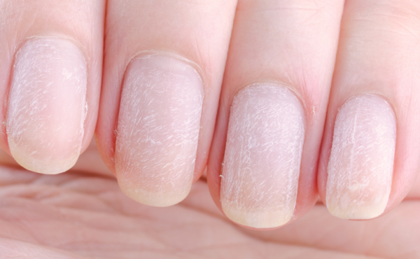 Uszkodzona macierz paznokcia – czy spotkał cię ten problem?