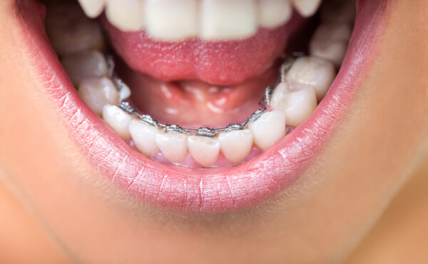 Niewidoczne nakładki czy aparaty ortodontyczne – która metoda jest lepsza?