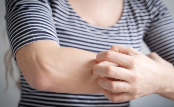 Masz dość uporczywych plam na skórze? Odkryj sprawdzony sposób na trwałe pożegnanie z łupieżem pstrym!