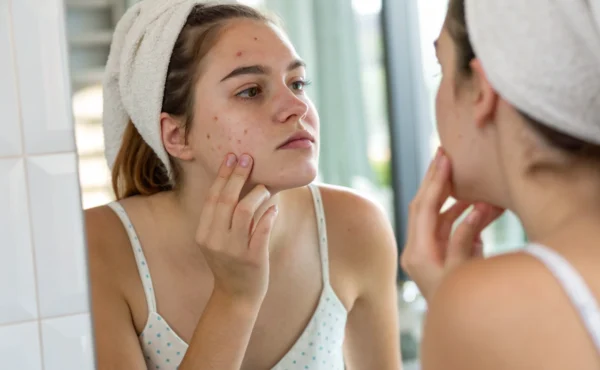 Pryszcze podskórne – skąd się biorą i jak je usunąć?