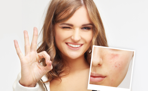 Domowe sposoby na trądzik